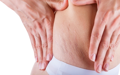 stretchmarks