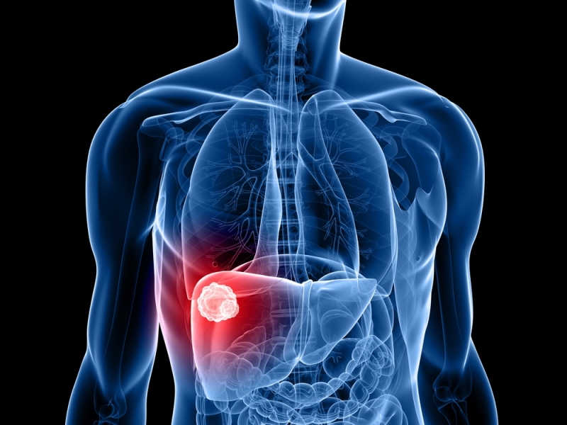 liver cancer