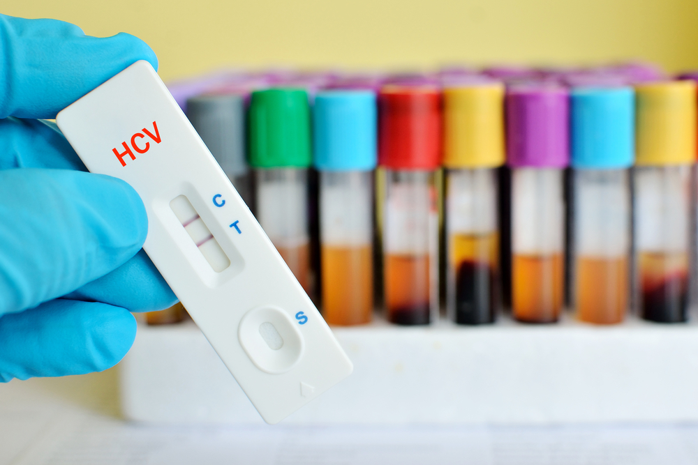 Rapid test cassette for hepatitis C virus (HCV) testing, the result showed positive .