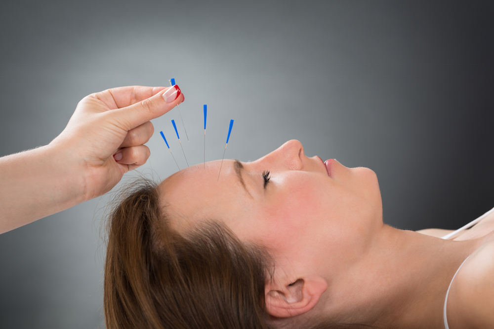 Close-up Person Hands Putting Acupuncture Needle On Face Of Young Woman