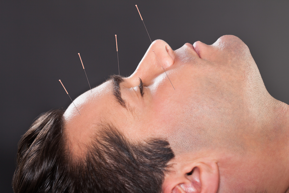 man receiving acupuncture treatment