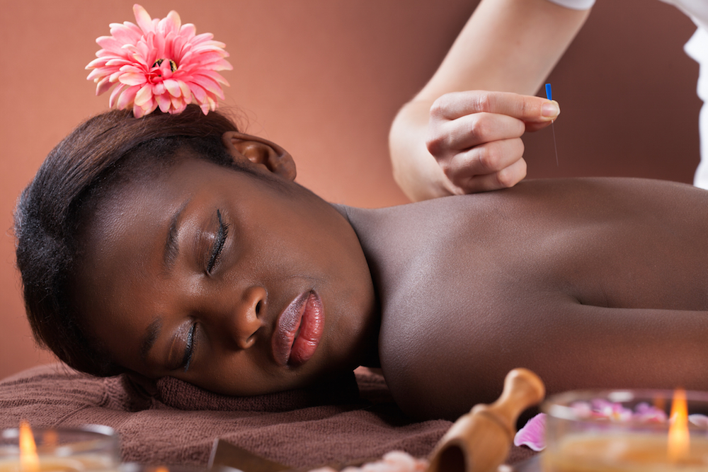 woman undergoing acupuncture therapy