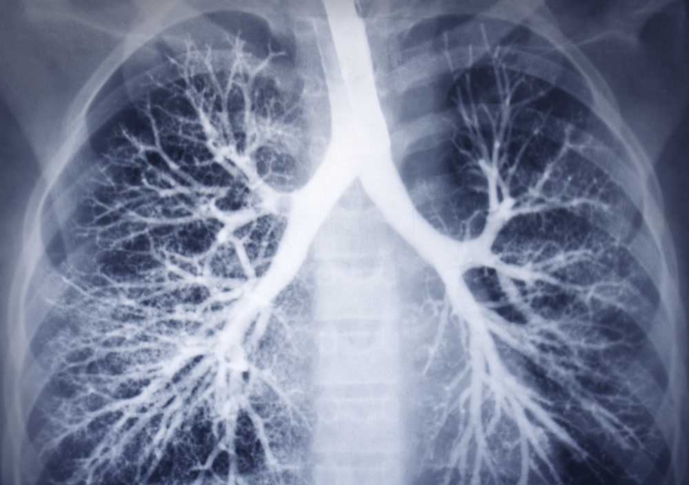 lungs xray